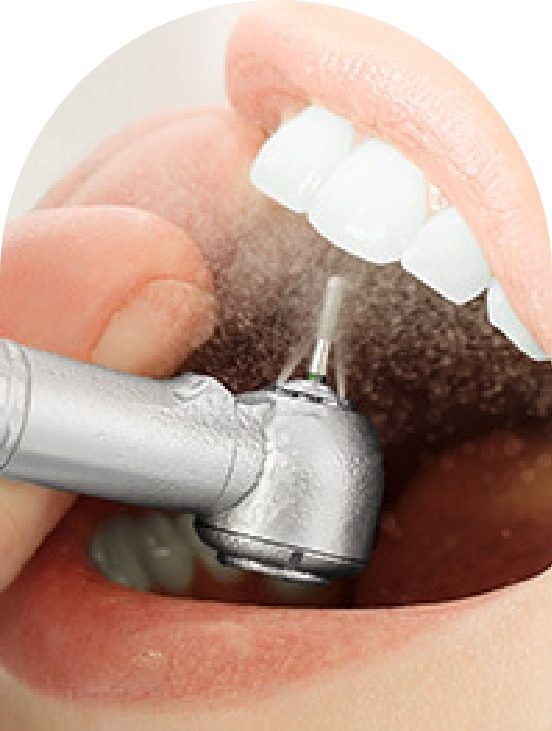 Airflow Teeth Cleaning in Barrow-in-Furness