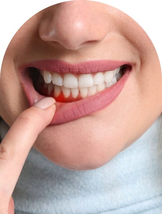 Best Gum Lift Treatment Barrow