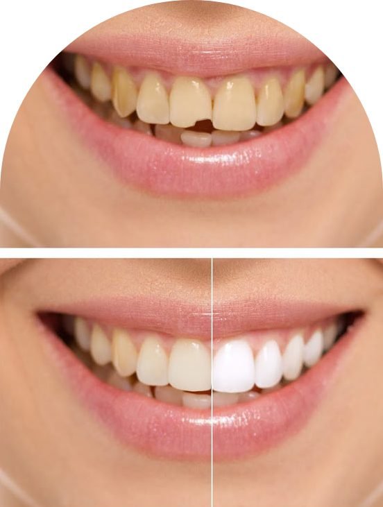 Composite Fillings At Barrow Dental Aesthetics