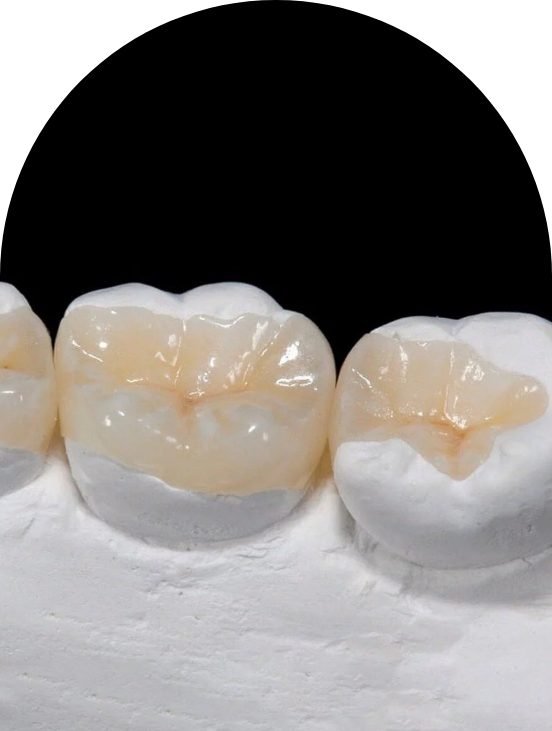 Dental Inlays & Onlays At Barrow Dental Aesthetics