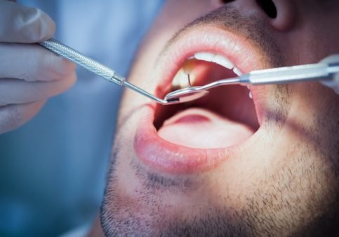 Gum Lift Treatment