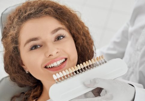 Veneers overview