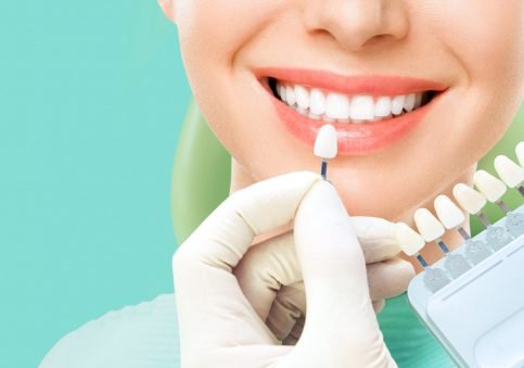 Veneers overview