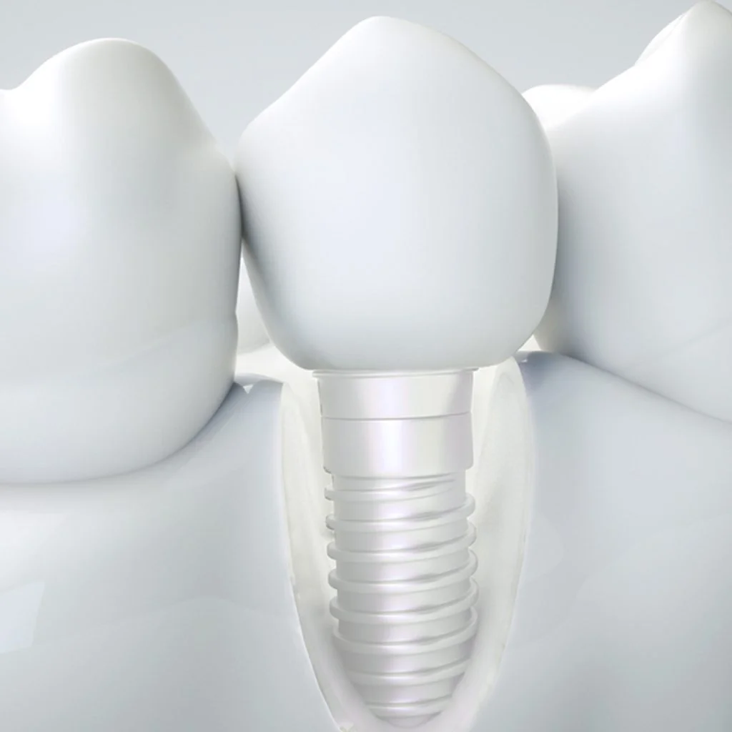 IMPLANTS